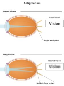Astigmatism Illustration White